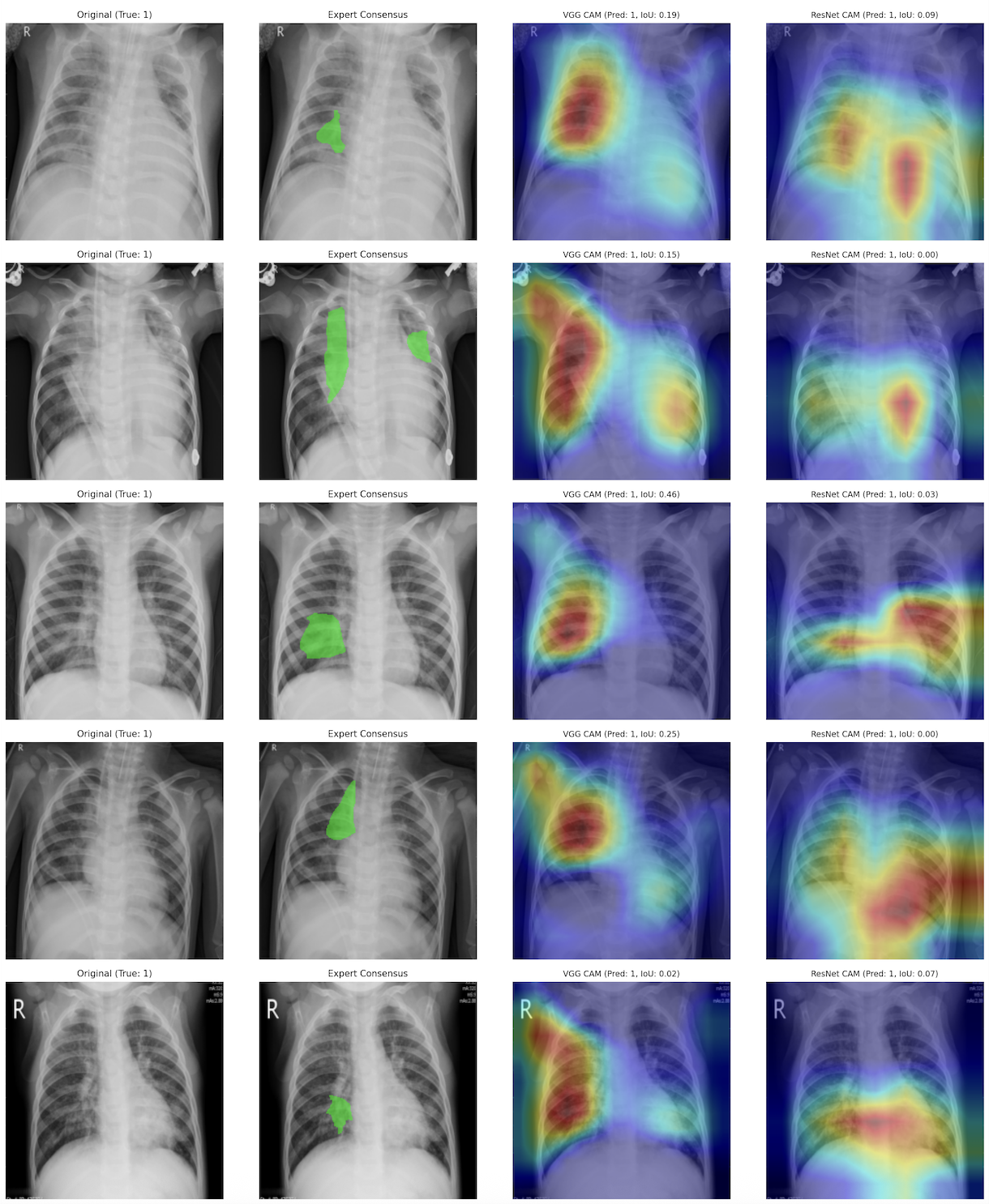 Do AI and Human Experts See Pneumonia the Same Way?